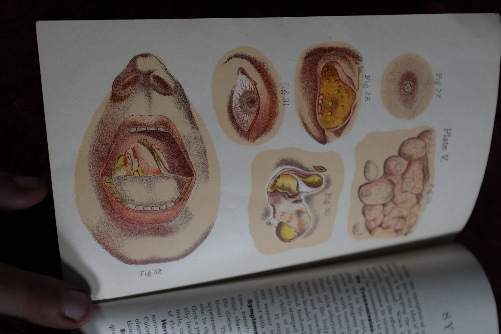 Lot 064 - Antique Pamhlet X, Venereal Disases, Gonorrhea And Syphilis, Including Stricture Of The Urethra, By The World'S Dispensary Medical Association, Buffalo, N.Y.