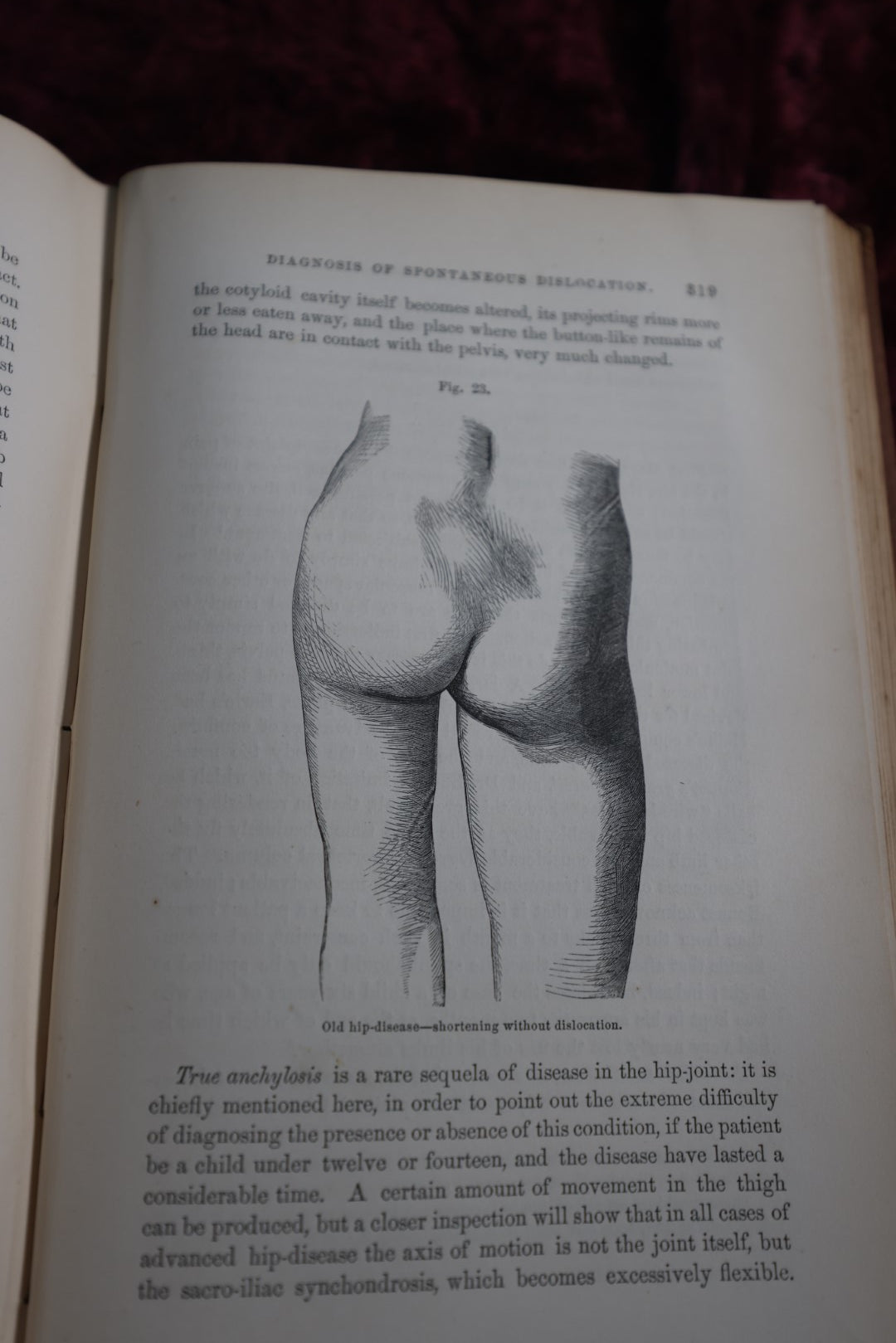 Lot 138 - Antique Medical Book, A Treatise On The Diseases Of The Joints, By Richard Barwell, Surgeon, 1861, Illustrated