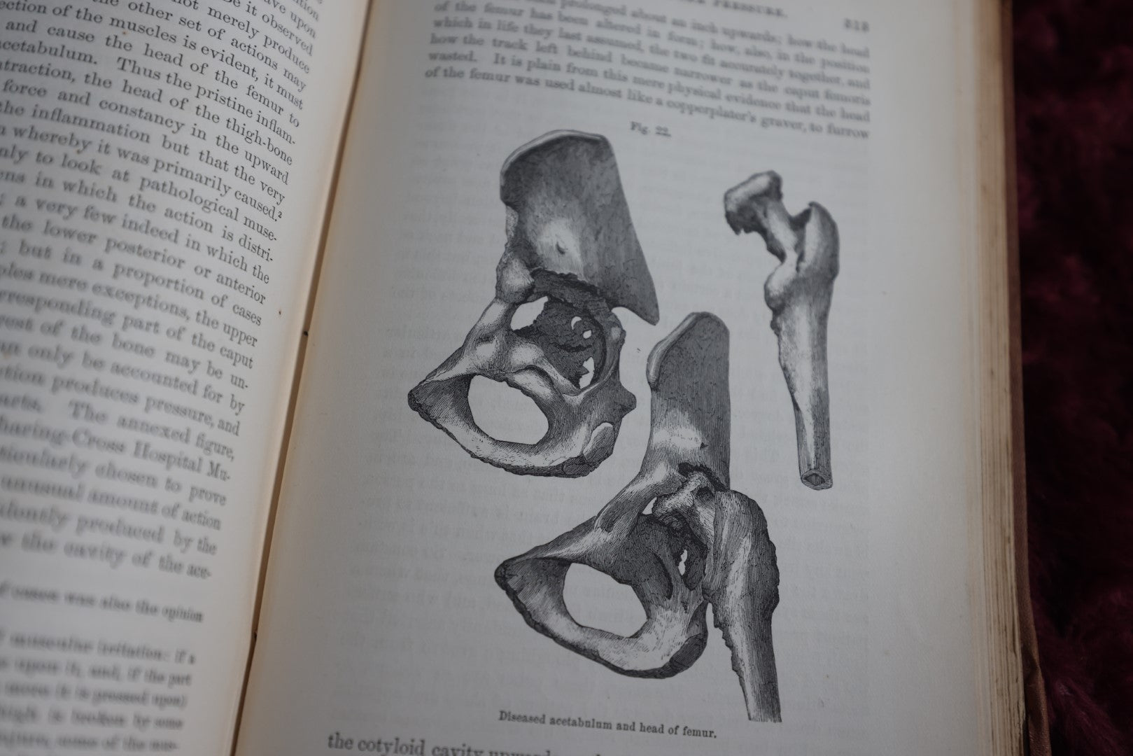 Lot 138 - Antique Medical Book, A Treatise On The Diseases Of The Joints, By Richard Barwell, Surgeon, 1861, Illustrated