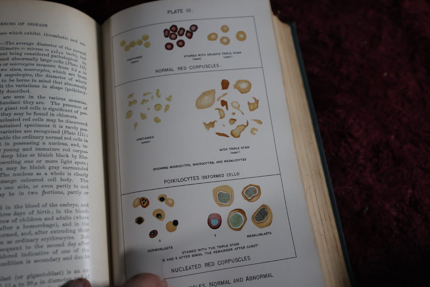 Lot 143 - Antique Medical Book, Diagnostics Of Internal Medicine, By Glenworth Reeve Buttler, M.D., 1905, Illustrated