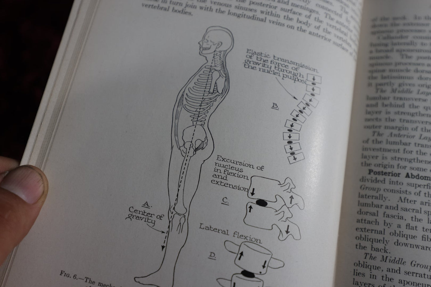 Lot 144 - Backache And Sciatic Neuritis Vintage Medical Book By Philip Lewin, M.D., Spine And Bones On Spine Of Book, 1944 Reprint