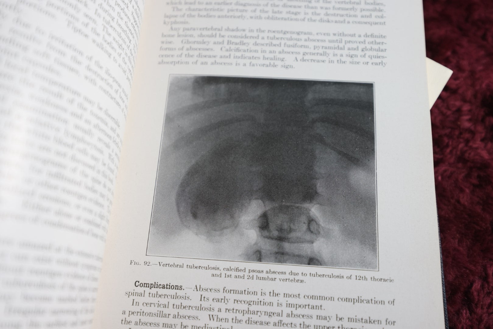 Lot 144 - Backache And Sciatic Neuritis Vintage Medical Book By Philip Lewin, M.D., Spine And Bones On Spine Of Book, 1944 Reprint