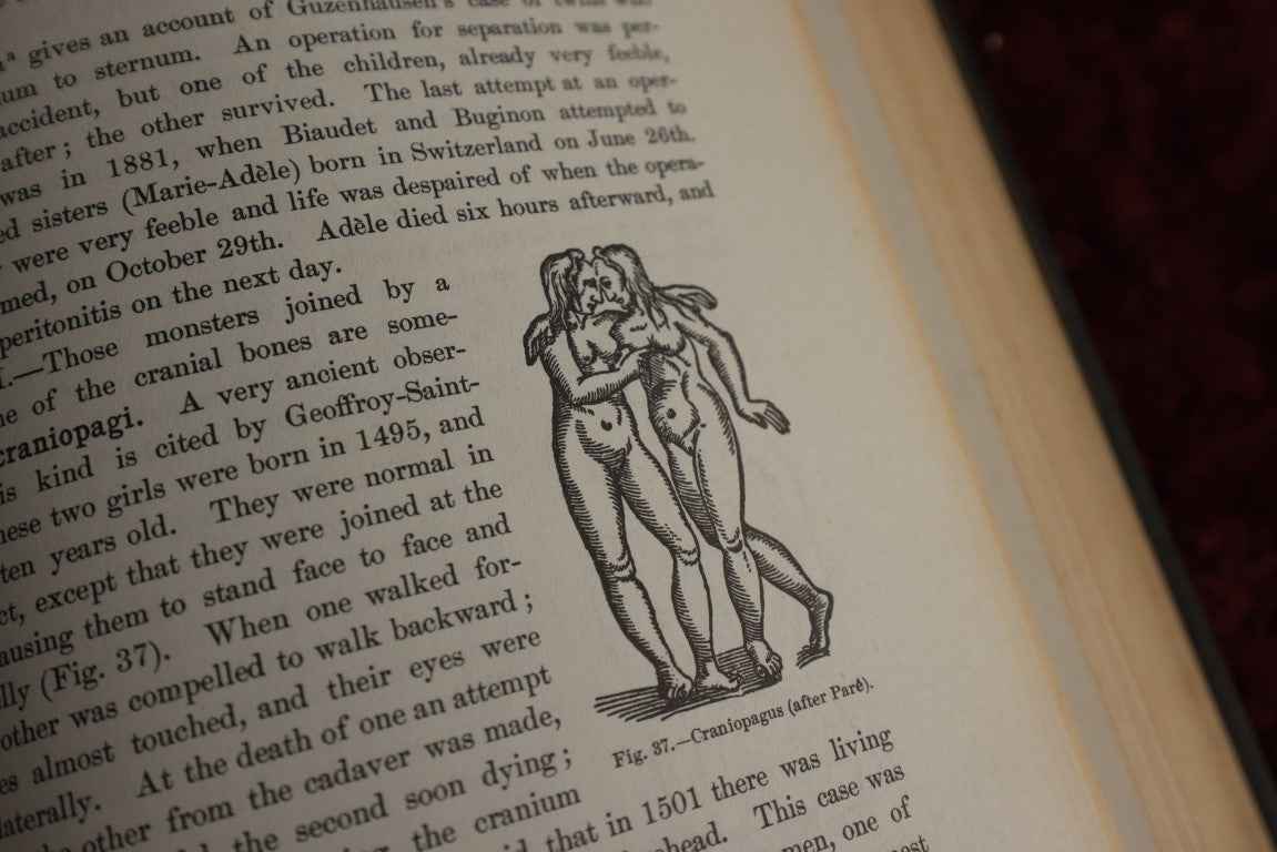 Lot 145 - Anomalies And Curiosities Of Medicine, Vintage Reprint Of Original 19th Century Book On Medical Oddities, 1956, Many Photos And Illustrations, Conjoined Twins, Bearded Ladies, Etc