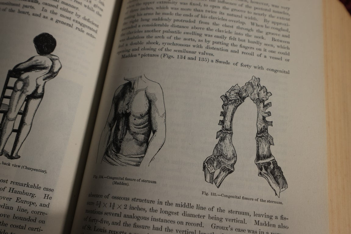 Lot 145 - Anomalies And Curiosities Of Medicine, Vintage Reprint Of Original 19th Century Book On Medical Oddities, 1956, Many Photos And Illustrations, Conjoined Twins, Bearded Ladies, Etc