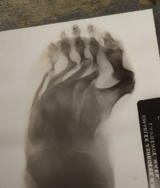 Lot 043 - Single Antique Magic Lantern Slide X-Ray Of Deformed Foot, By Charles J. Burgess, M.D.