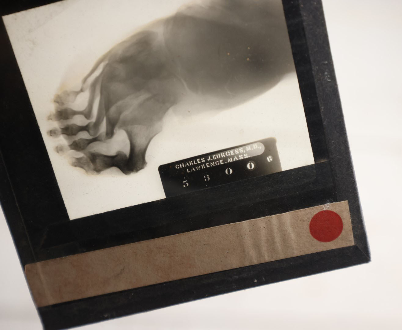 Lot 043 - Single Antique Magic Lantern Slide X-Ray Of Deformed Foot, By Charles J. Burgess, M.D.