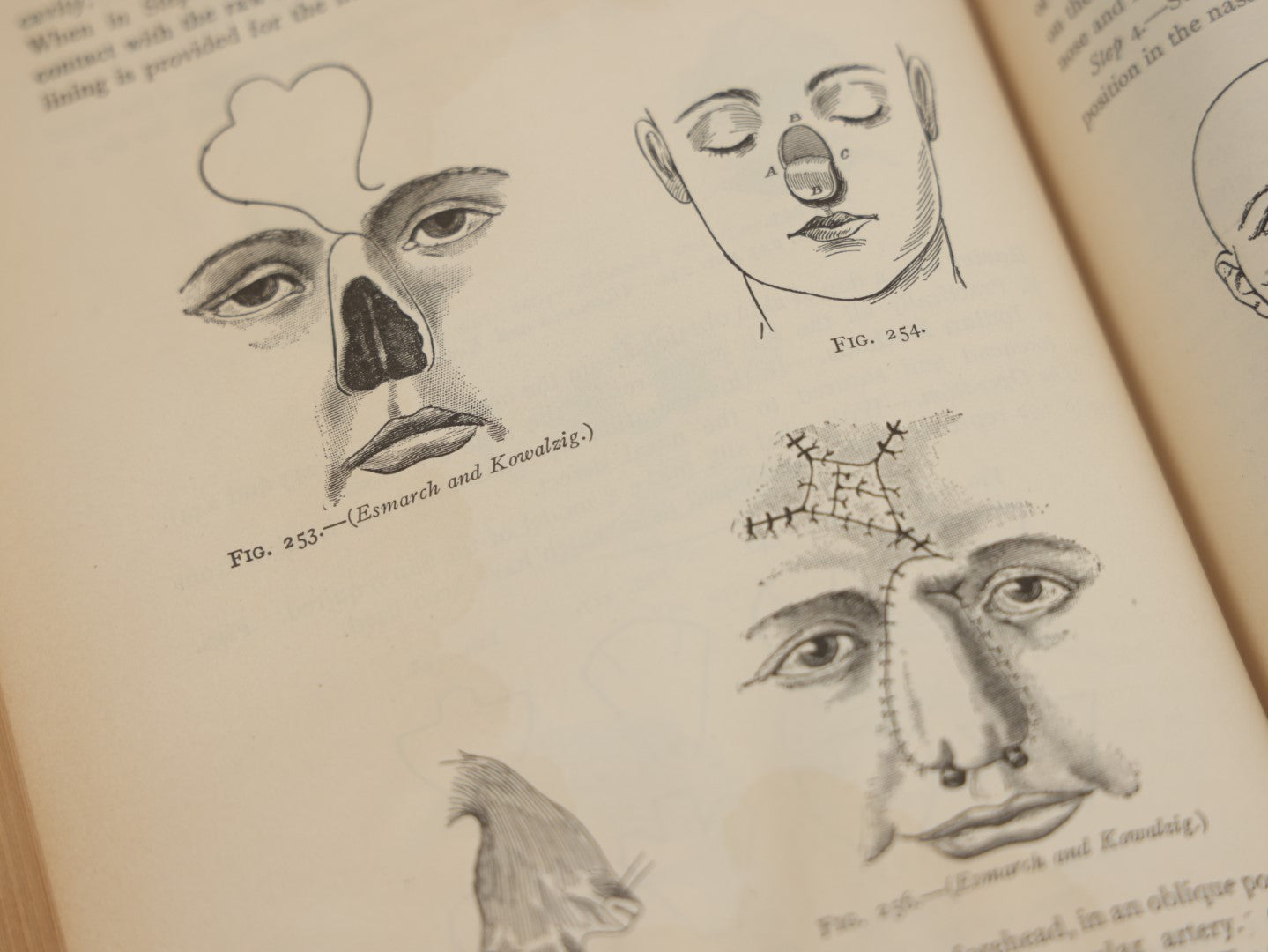 Lot 032 - "Manual Of Operative Surgery" Antique Medical Anatomy Book By John Fairbairn Binnie, With 1365 Illustrations, Including Many In Color, Fifth Edition, Published 1912