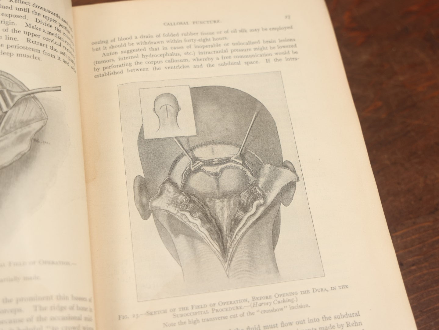 Lot 032 - "Manual Of Operative Surgery" Antique Medical Anatomy Book By John Fairbairn Binnie, With 1365 Illustrations, Including Many In Color, Fifth Edition, Published 1912