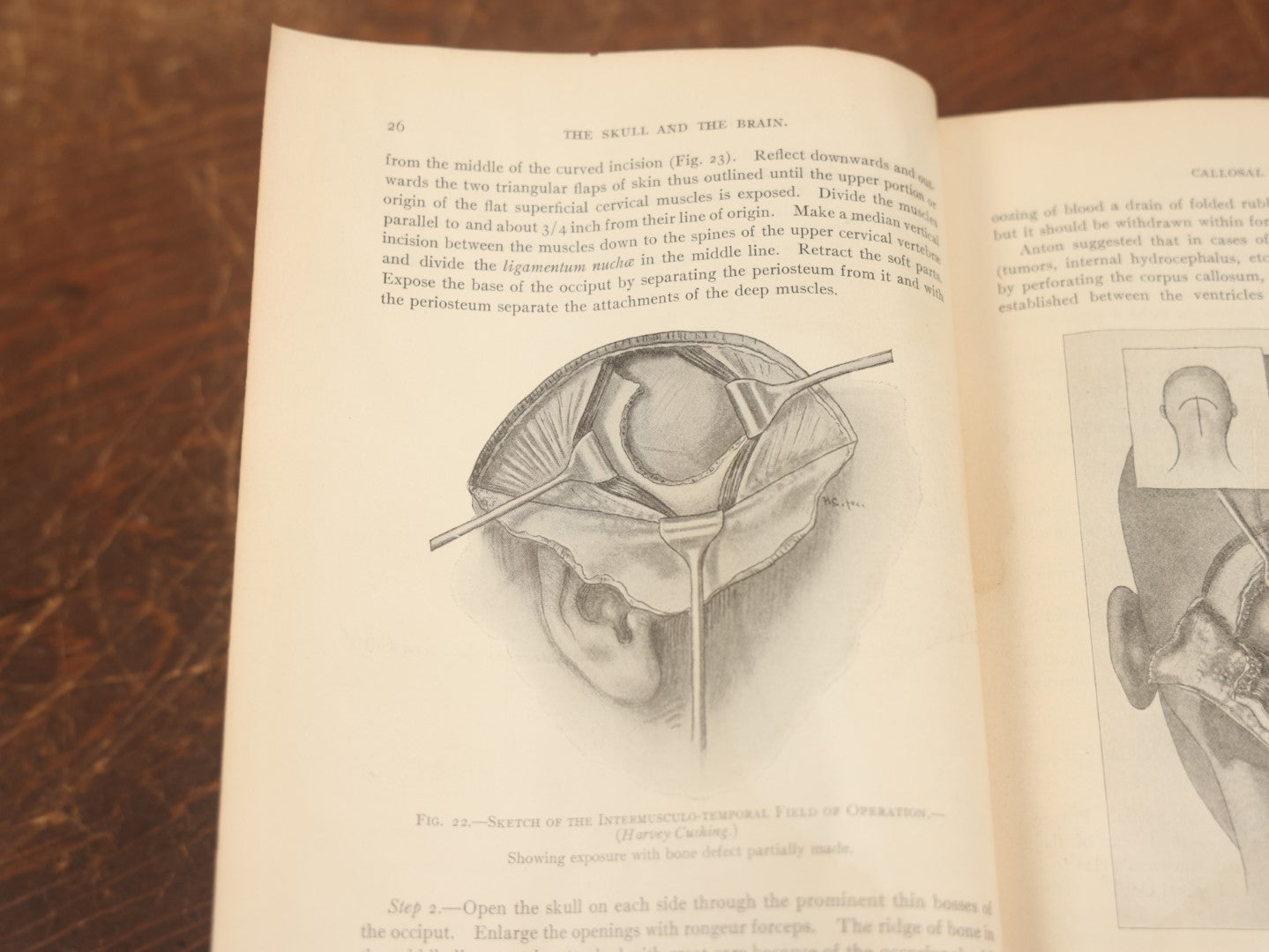 Lot 032 - "Manual Of Operative Surgery" Antique Medical Anatomy Book By John Fairbairn Binnie, With 1365 Illustrations, Including Many In Color, Fifth Edition, Published 1912