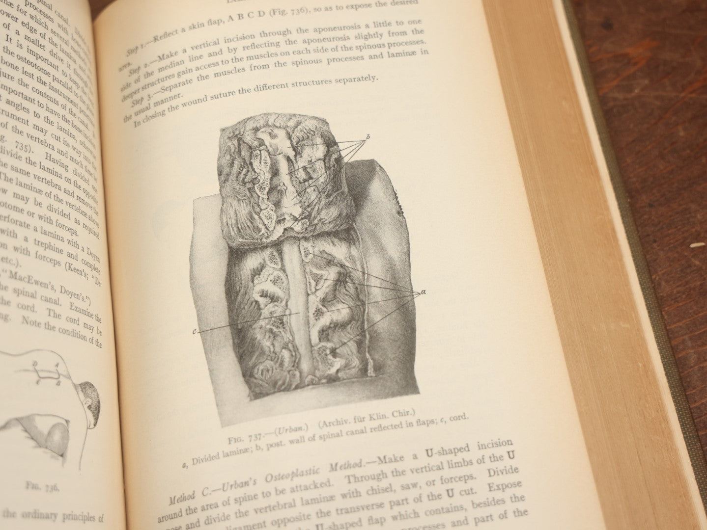 Lot 032 - "Manual Of Operative Surgery" Antique Medical Anatomy Book By John Fairbairn Binnie, With 1365 Illustrations, Including Many In Color, Fifth Edition, Published 1912