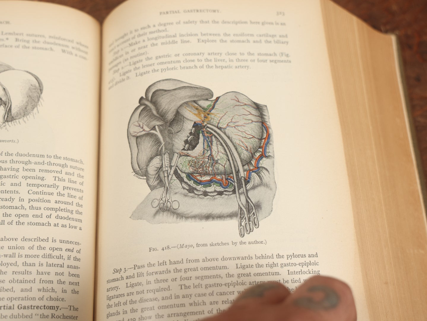 Lot 032 - "Manual Of Operative Surgery" Antique Medical Anatomy Book By John Fairbairn Binnie, With 1365 Illustrations, Including Many In Color, Fifth Edition, Published 1912