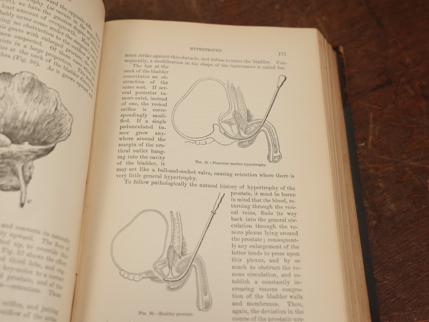 Lot 033 - "The Surgical Diseases Of The Genit-Urinary Organs Including Syphilis" Antique Medical Book By E.L. Keyes, M.D., Sparsely Illustrated, 1895