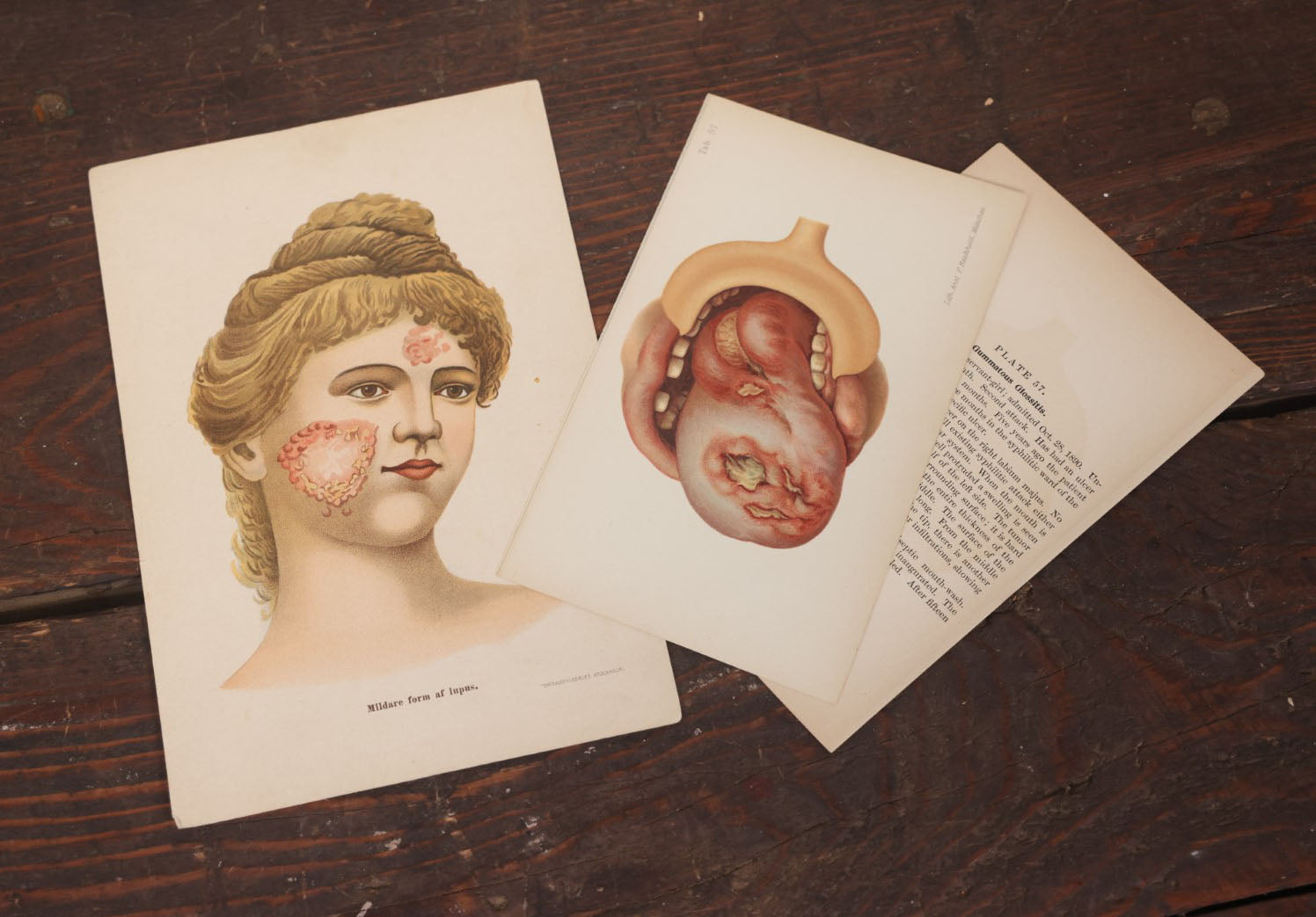 Lot 104 - Pair Of Antique Chromolithograph Medical Book Plates Depicting Skin Lesions, Lupus, Munich And Stockholm