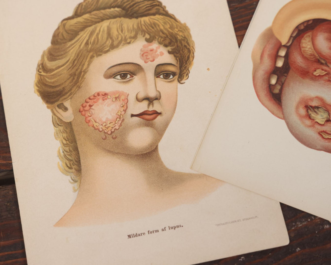 Lot 104 - Pair Of Antique Chromolithograph Medical Book Plates Depicting Skin Lesions, Lupus, Munich And Stockholm