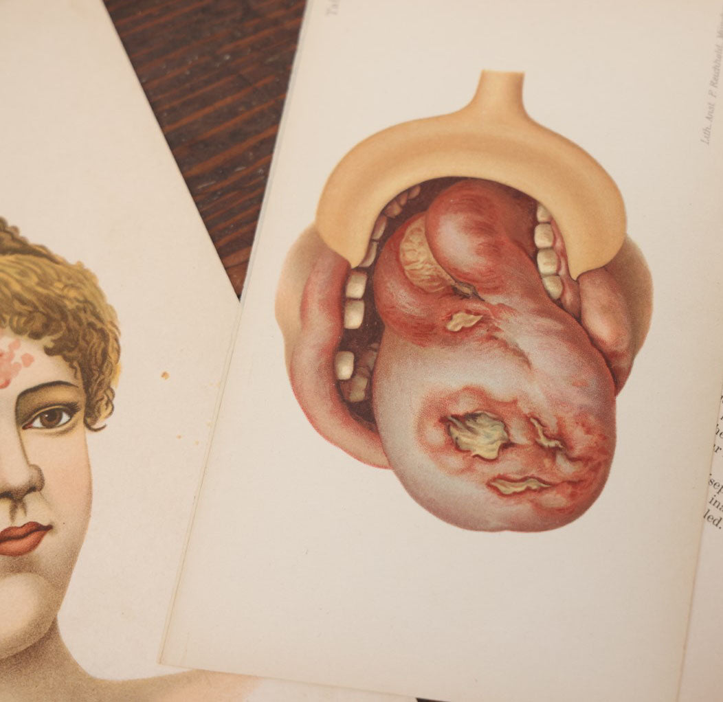 Lot 104 - Pair Of Antique Chromolithograph Medical Book Plates Depicting Skin Lesions, Lupus, Munich And Stockholm