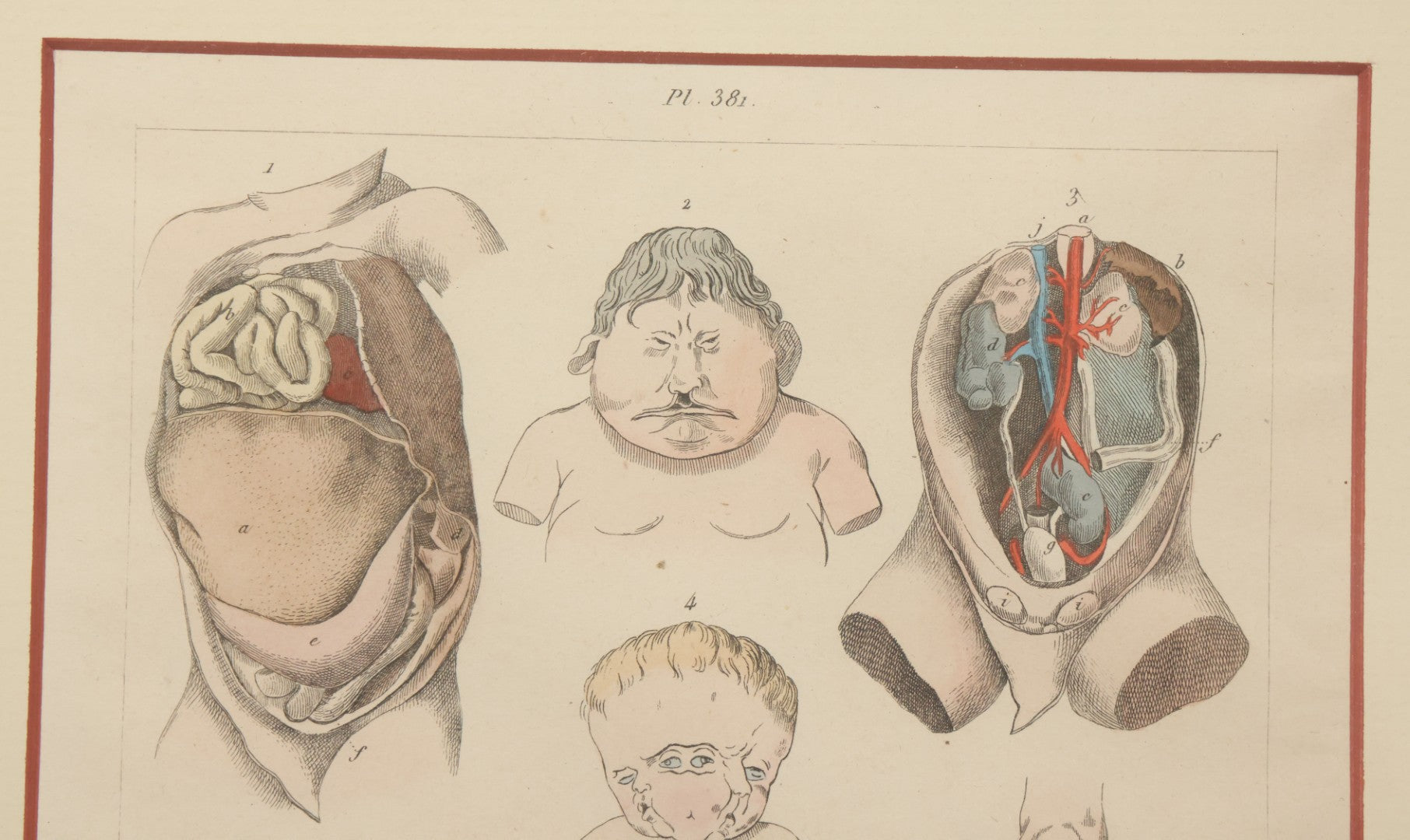 Lot 054 - Antique French Medical Engraving Plate Print, "Monstruosités" (Monstrosities), Featuring Many Medical Oddities, Engraved By Pedretti After Martin St. Ange, In Modern Frame, 10-1/2" x 13-3/8"