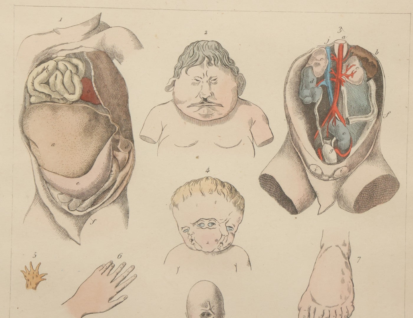 Lot 054 - Antique French Medical Engraving Plate Print, "Monstruosités" (Monstrosities), Featuring Many Medical Oddities, Engraved By Pedretti After Martin St. Ange, In Modern Frame, 10-1/2" x 13-3/8"