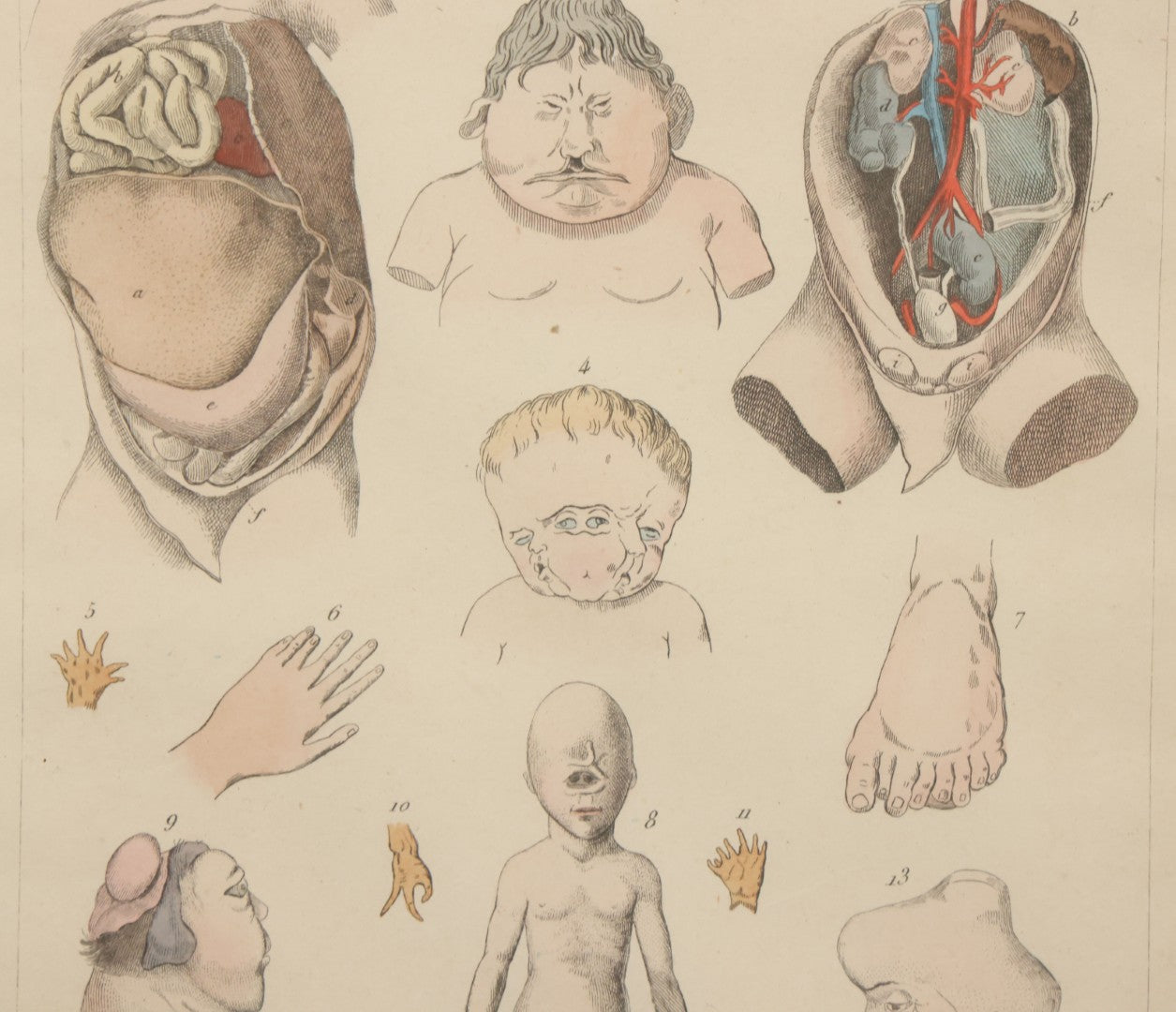 Lot 054 - Antique French Medical Engraving Plate Print, "Monstruosités" (Monstrosities), Featuring Many Medical Oddities, Engraved By Pedretti After Martin St. Ange, In Modern Frame, 10-1/2" x 13-3/8"