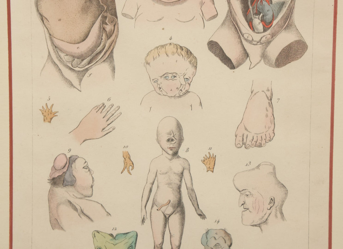 Lot 054 - Antique French Medical Engraving Plate Print, "Monstruosités" (Monstrosities), Featuring Many Medical Oddities, Engraved By Pedretti After Martin St. Ange, In Modern Frame, 10-1/2" x 13-3/8"