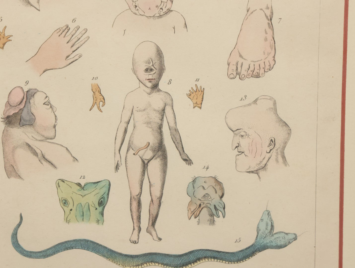 Lot 054 - Antique French Medical Engraving Plate Print, "Monstruosités" (Monstrosities), Featuring Many Medical Oddities, Engraved By Pedretti After Martin St. Ange, In Modern Frame, 10-1/2" x 13-3/8"