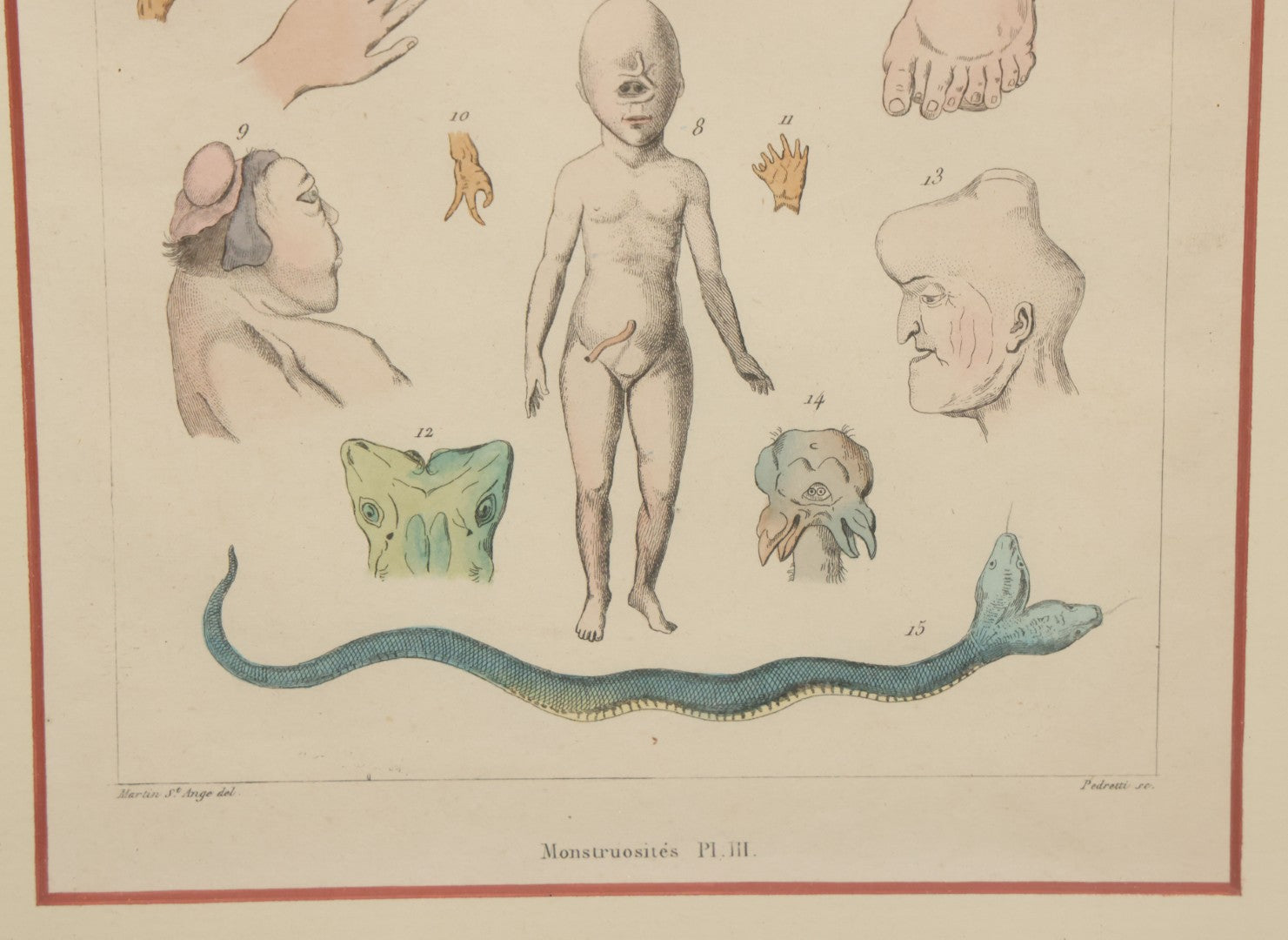 Lot 054 - Antique French Medical Engraving Plate Print, "Monstruosités" (Monstrosities), Featuring Many Medical Oddities, Engraved By Pedretti After Martin St. Ange, In Modern Frame, 10-1/2" x 13-3/8"