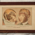 Lot 065 - Antique Skin Condition Medical Print, Milk Crust & Scaled Head, From Photographs Of Skin Diseases Under The Direction Of George Henry Fox, M.D., Published By E.B. Treat, New York, In Custom Frame, 10-7/8" x 7-7/8"