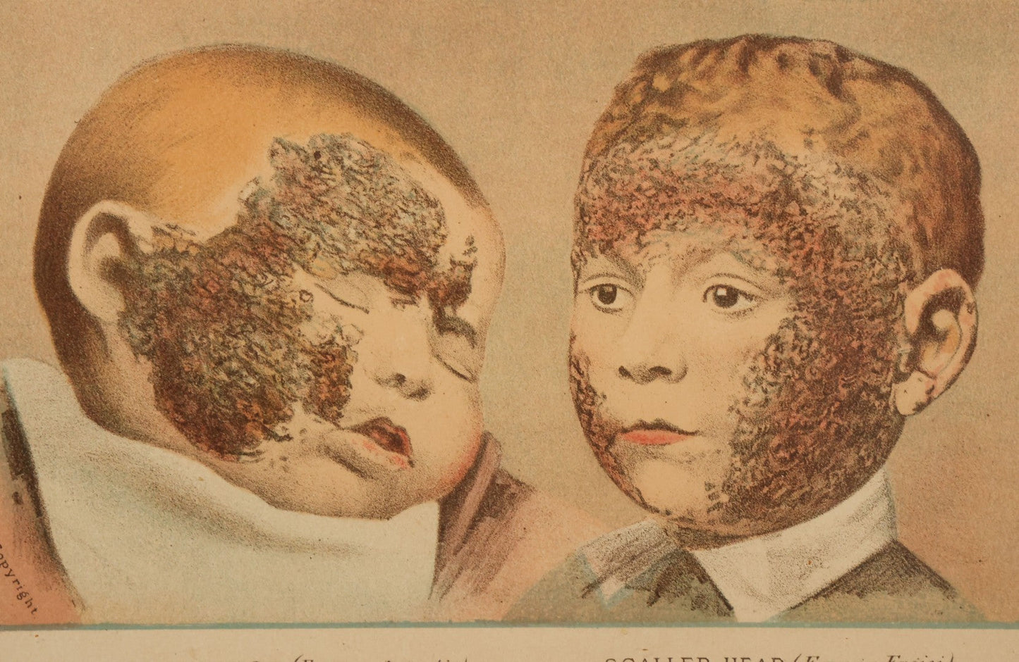 Lot 065 - Antique Skin Condition Medical Print, Milk Crust & Scaled Head, From Photographs Of Skin Diseases Under The Direction Of George Henry Fox, M.D., Published By E.B. Treat, New York, In Custom Frame, 10-7/8" x 7-7/8"