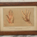 Lot 066 - Antique Skin Condition Medical Print, Salt Rheum & Itch, From Photographs Of Skin Diseases Under The Direction Of George Henry Fox, M.D., Published By E.B. Treat, New York, In Custom Frame, 11" x 8"