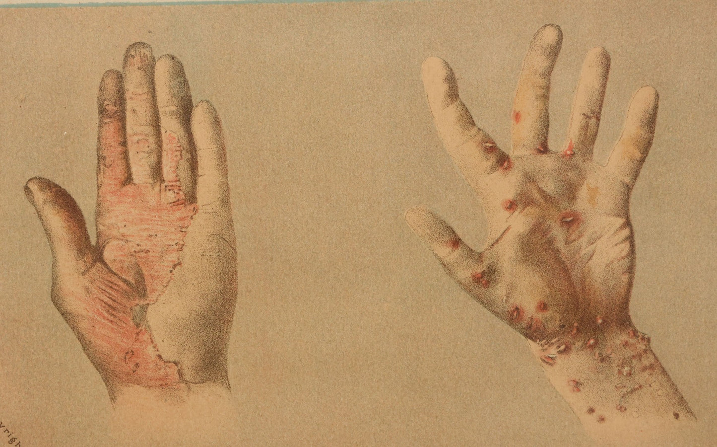 Lot 066 - Antique Skin Condition Medical Print, Salt Rheum & Itch, From Photographs Of Skin Diseases Under The Direction Of George Henry Fox, M.D., Published By E.B. Treat, New York, In Custom Frame, 11" x 8"