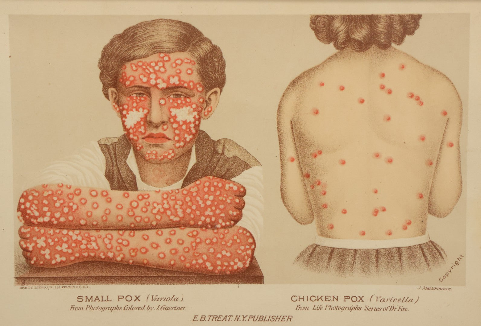 Lot 067 - Antique Skin Condition Medical Print, Small Pox & Chicken Pox, From Photographs Of Skin Diseases Under The Direction Of George Henry Fox, M.D., Published By E.B. Treat, New York, In Custom Frame, 11-1/8" x 8"