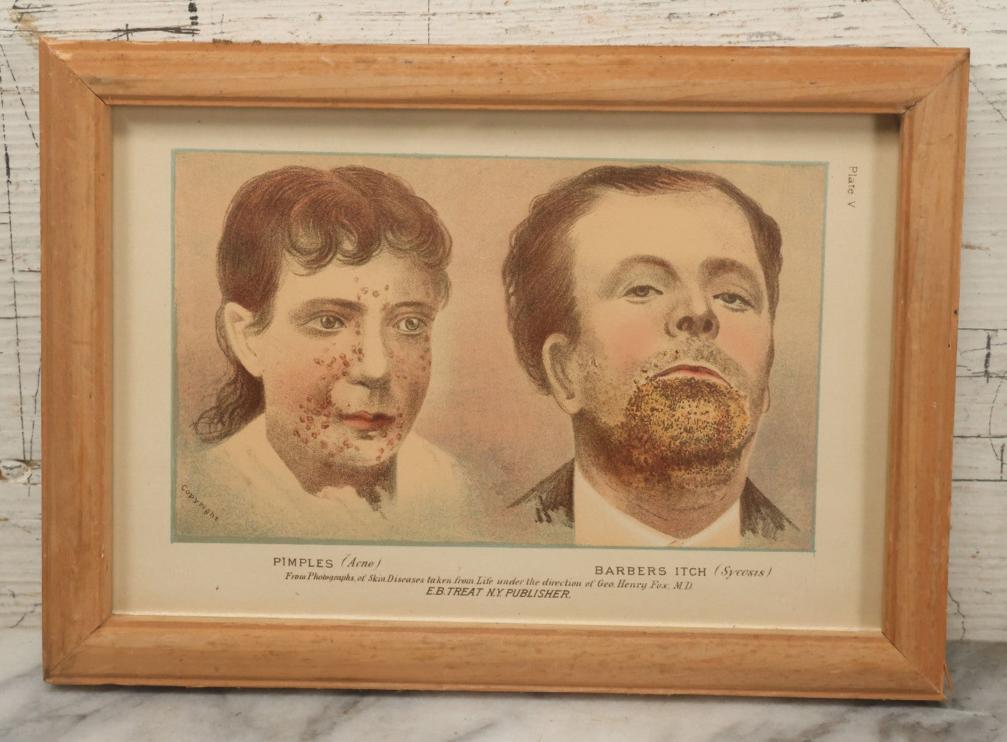Lot 068 - Antique Skin Condition Medical Print, Pimples & Barber's Itch, From Photographs Of Skin Diseases Under The Direction Of George Henry Fox, M.D., Published By E.B. Treat, New York, In Custom Frame, 10-1/2" x 7-1/2"