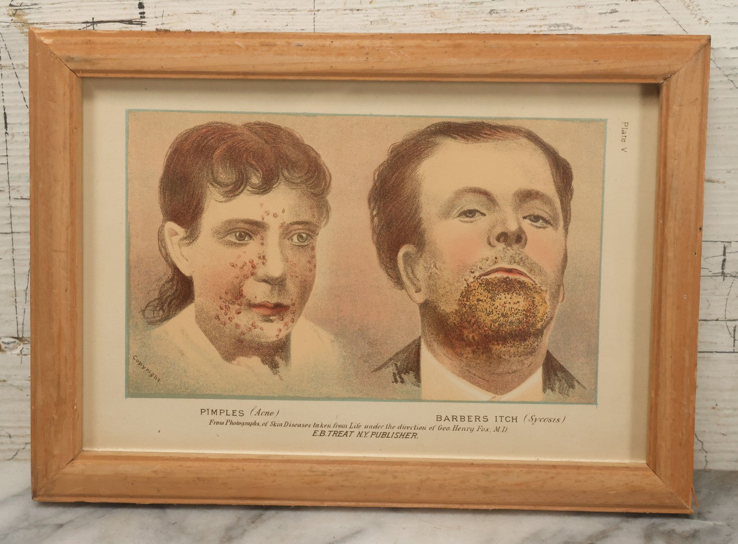 Lot 068 - Antique Skin Condition Medical Print, Pimples & Barber's Itch, From Photographs Of Skin Diseases Under The Direction Of George Henry Fox, M.D., Published By E.B. Treat, New York, In Custom Frame, 10-1/2" x 7-1/2"