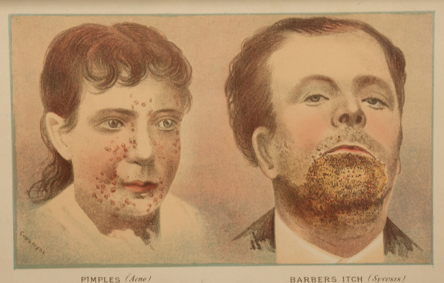 Lot 068 - Antique Skin Condition Medical Print, Pimples & Barber's Itch, From Photographs Of Skin Diseases Under The Direction Of George Henry Fox, M.D., Published By E.B. Treat, New York, In Custom Frame, 10-1/2" x 7-1/2"