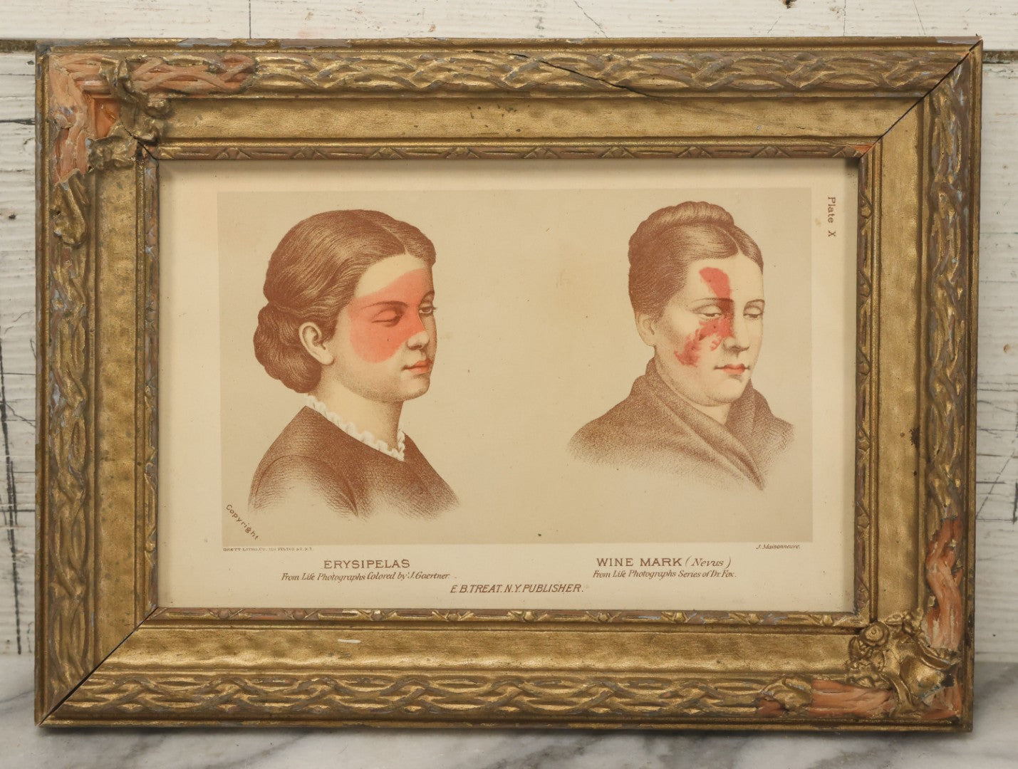 Lot 069 - Antique Skin Condition Medical Print, Erysipelas & Wine Mark, From Photographs Of Skin Diseases Under The Direction Of George Henry Fox, M.D., Published By E.B. Treat, New York, In Custom Frame, 12-1/8" x 9"