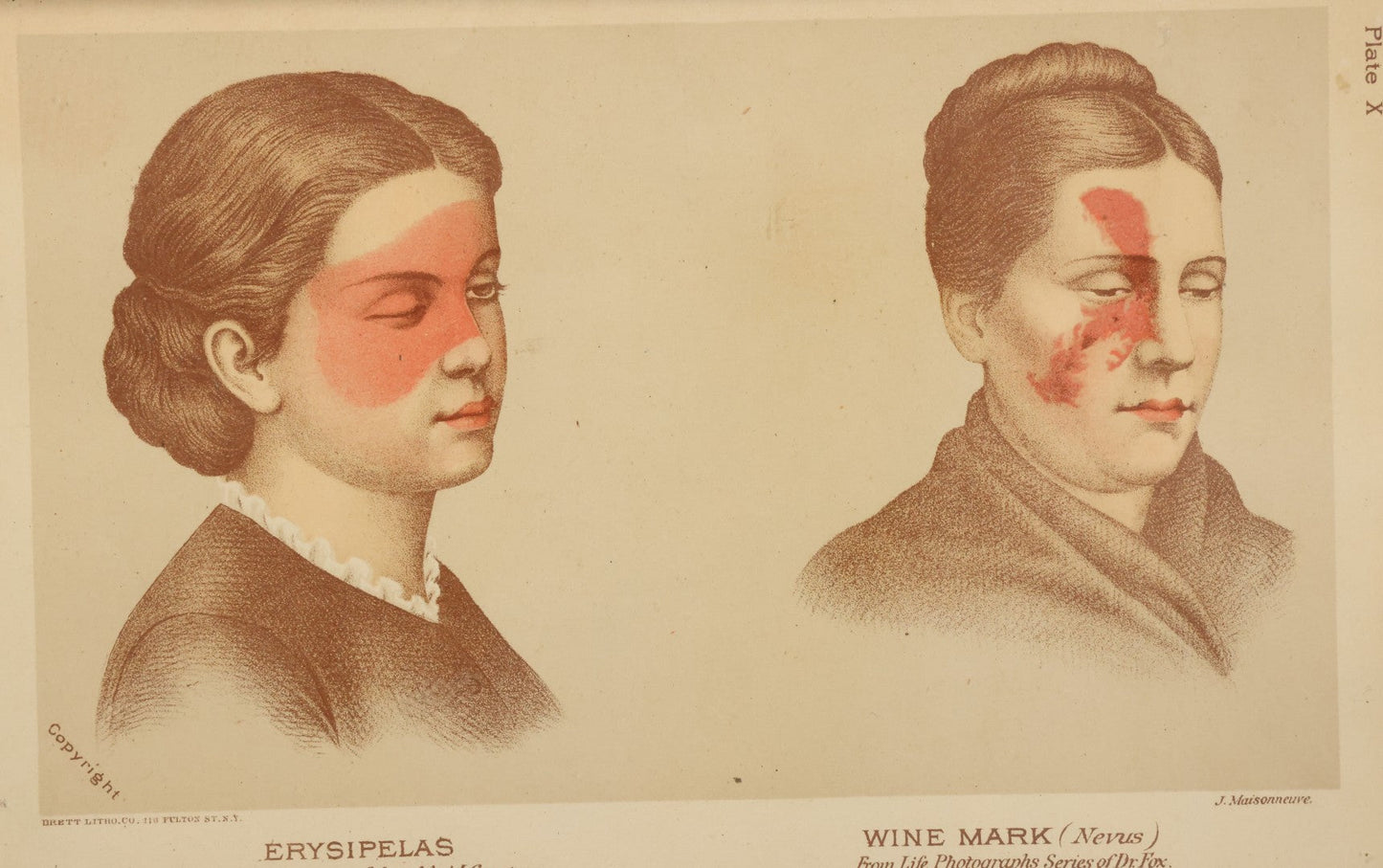 Lot 069 - Antique Skin Condition Medical Print, Erysipelas & Wine Mark, From Photographs Of Skin Diseases Under The Direction Of George Henry Fox, M.D., Published By E.B. Treat, New York, In Custom Frame, 12-1/8" x 9"