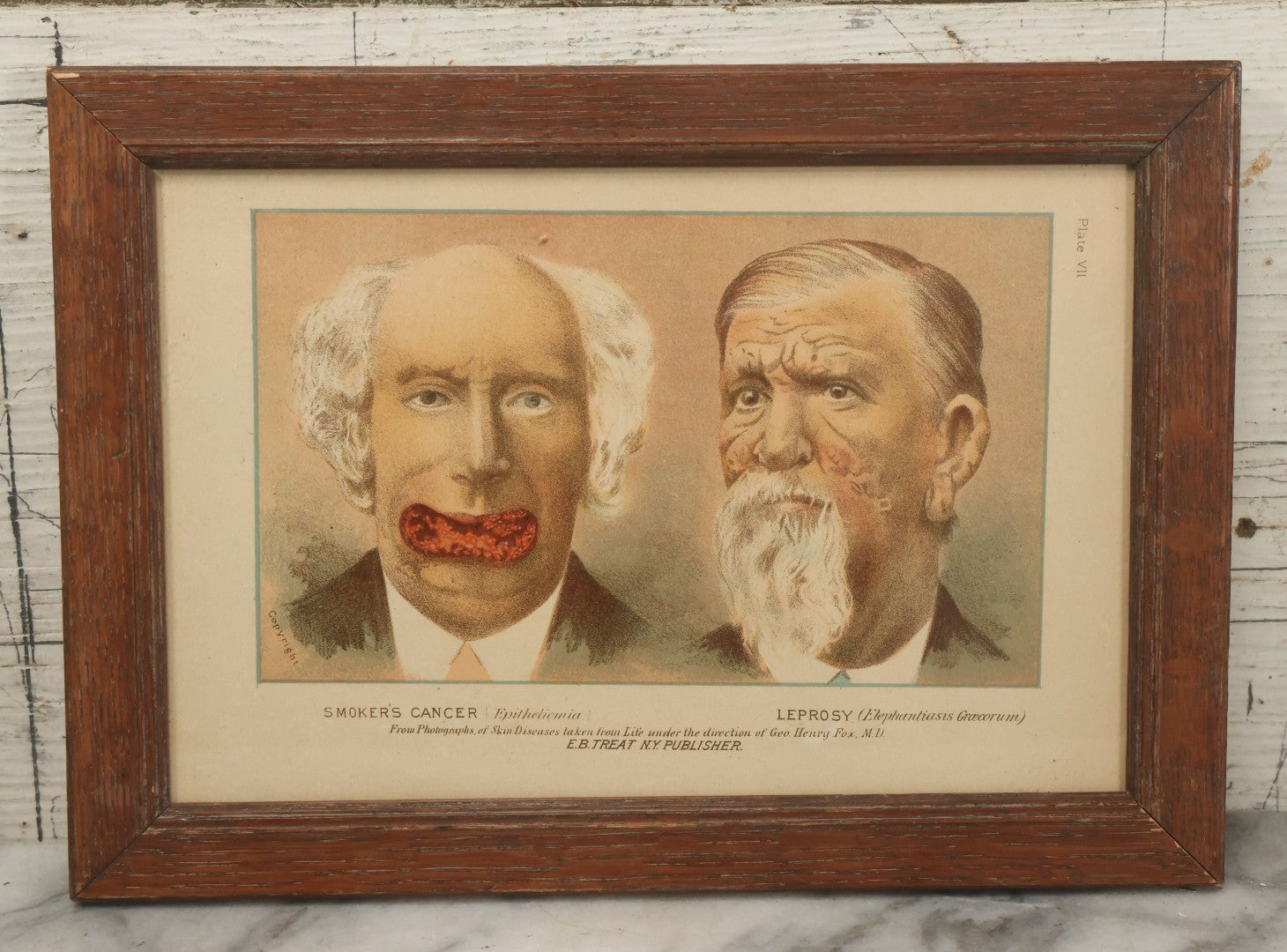 Lot 070 - Antique Skin Condition Medical Print, Smoker's Cancer & Leprosy, From Photographs Of Skin Diseases Under The Direction Of George Henry Fox, M.D., Published By E.B. Treat, New York, In Custom Frame, 11-1/4" x 8"