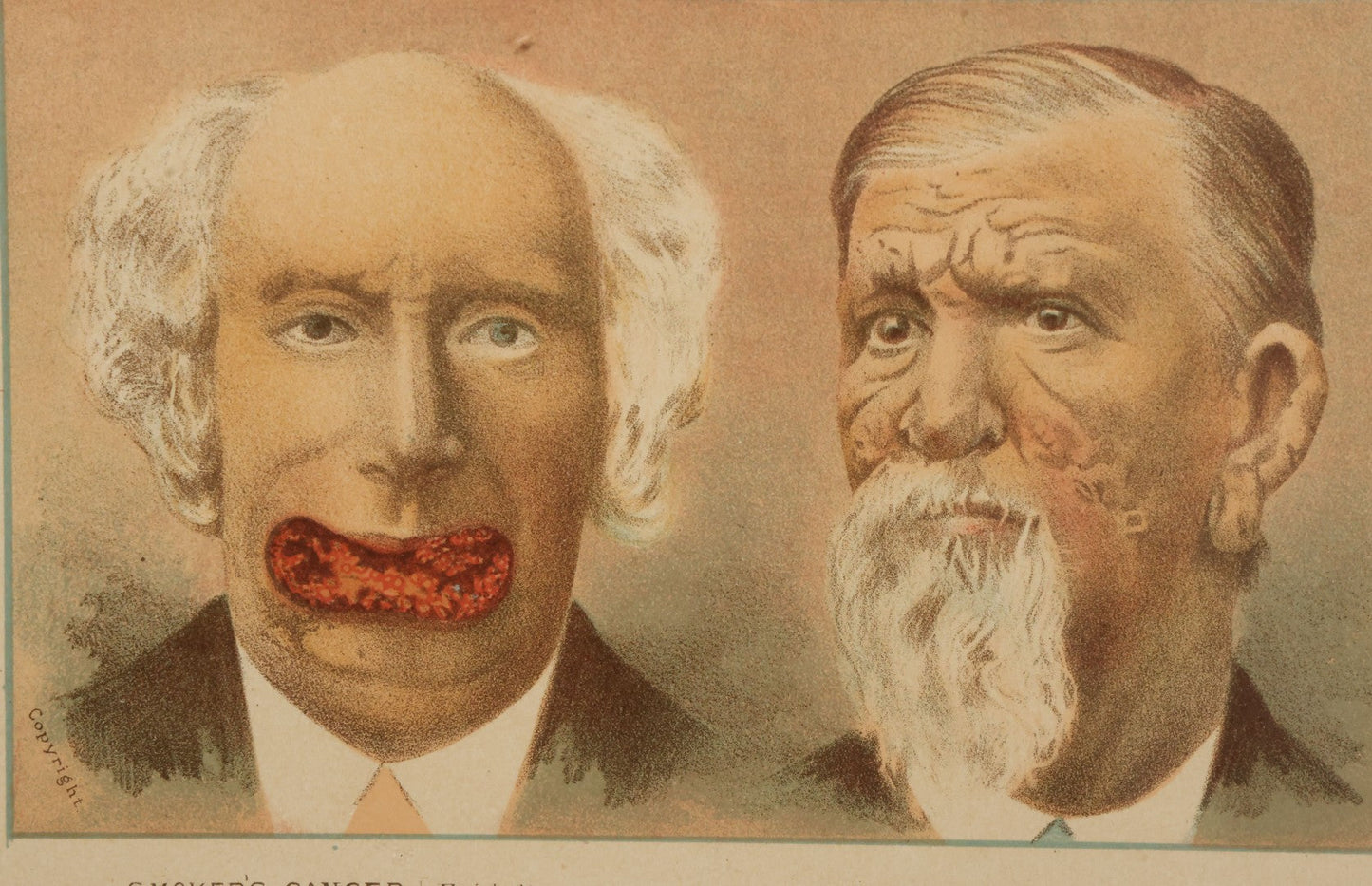 Lot 070 - Antique Skin Condition Medical Print, Smoker's Cancer & Leprosy, From Photographs Of Skin Diseases Under The Direction Of George Henry Fox, M.D., Published By E.B. Treat, New York, In Custom Frame, 11-1/4" x 8"