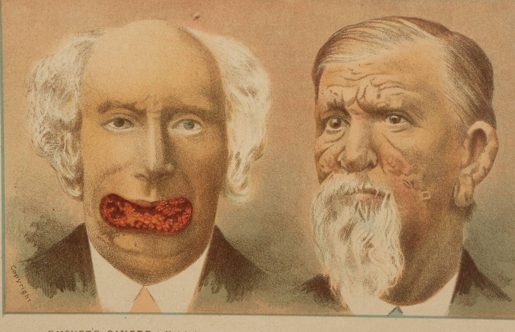 Lot 070 - Antique Skin Condition Medical Print, Smoker's Cancer & Leprosy, From Photographs Of Skin Diseases Under The Direction Of George Henry Fox, M.D., Published By E.B. Treat, New York, In Custom Frame, 11-1/4" x 8"