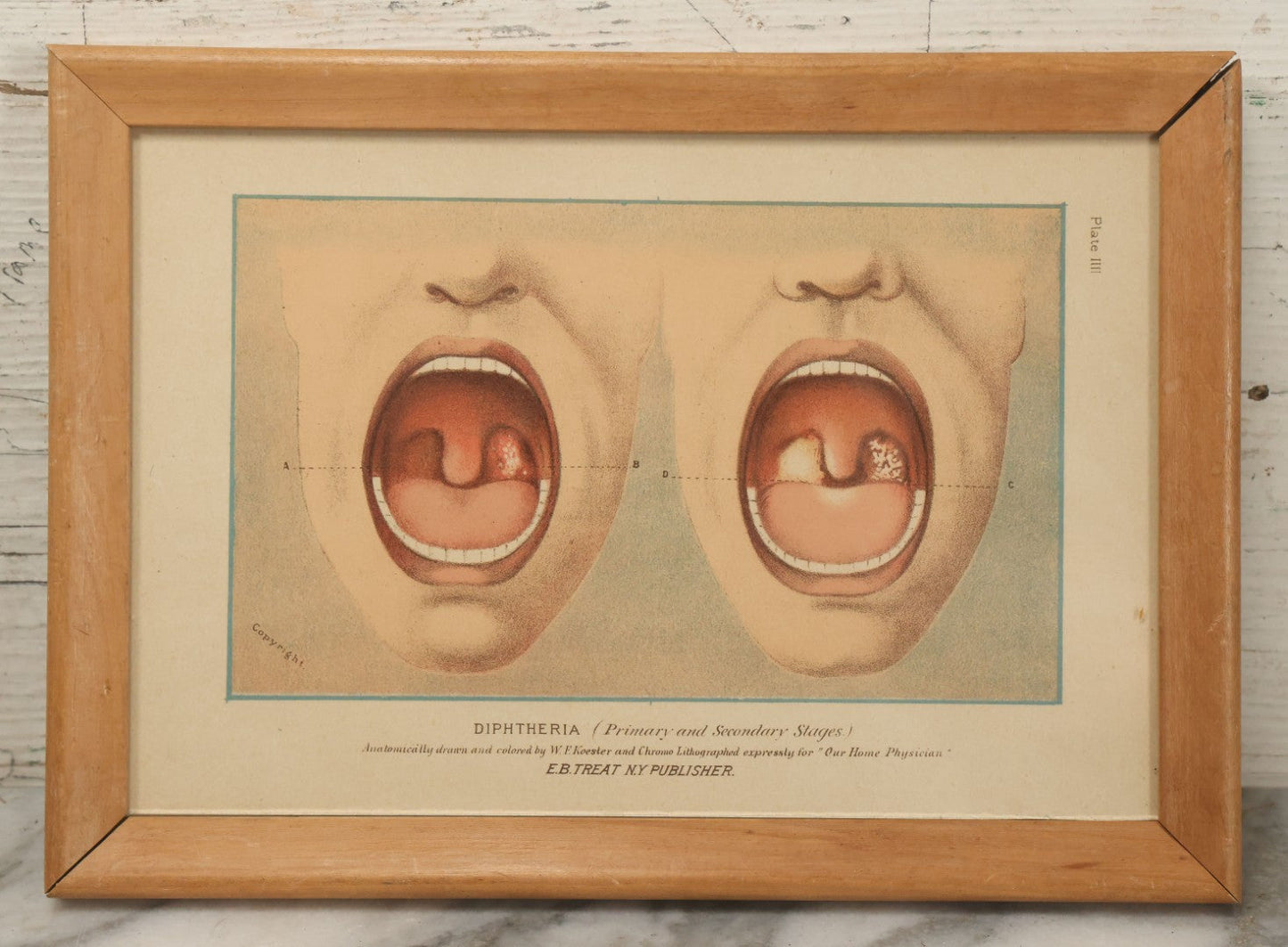 Lot 071 - Antique Skin Condition Medical Print, Diphtheria, From Photographs Of Skin Diseases Under The Direction Of George Henry Fox, M.D., Published By E.B. Treat, New York, In Custom Frame, 10-3/4" x 7-3/4"