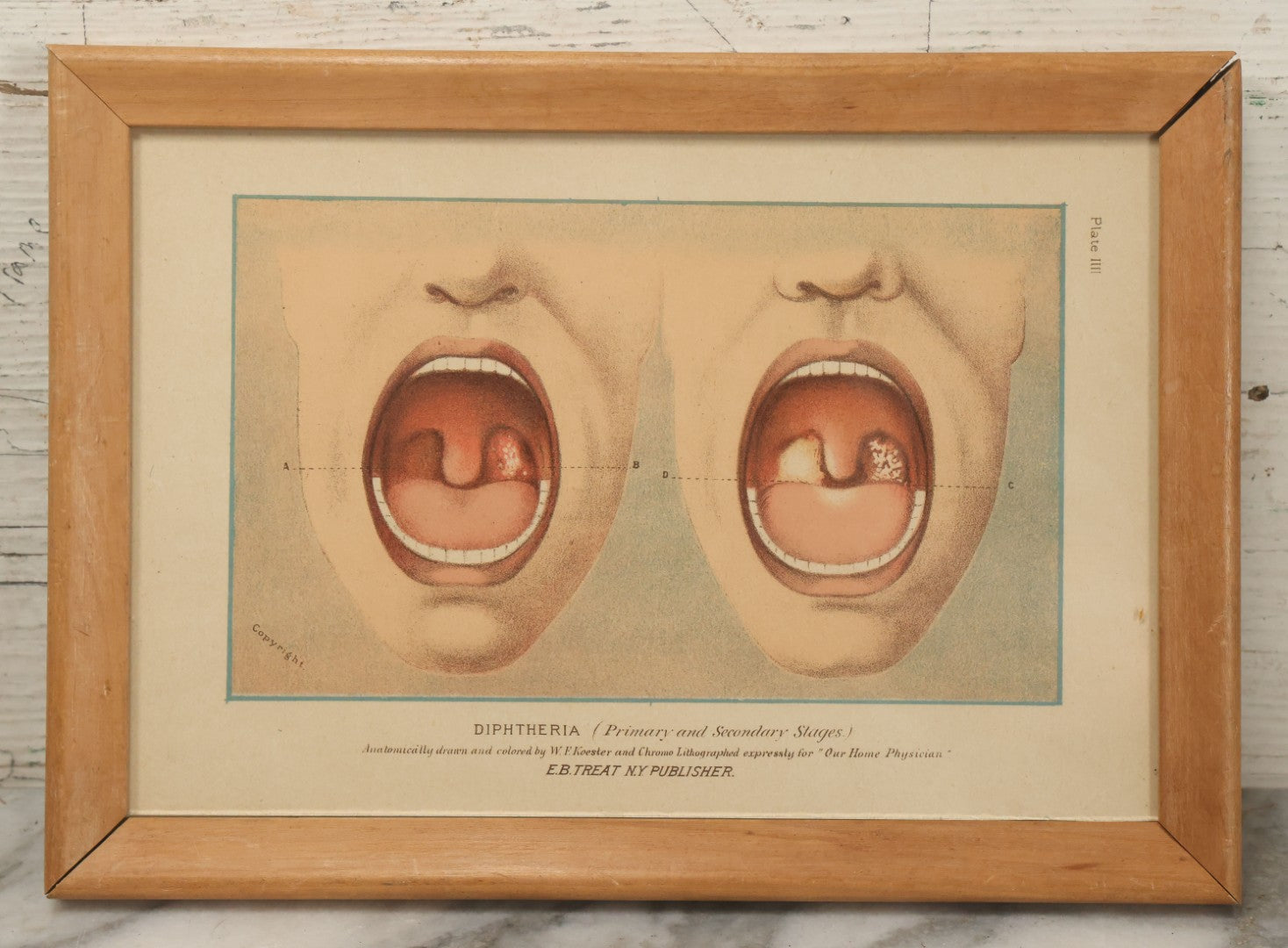 Lot 071 - Antique Skin Condition Medical Print, Diphtheria, From Photographs Of Skin Diseases Under The Direction Of George Henry Fox, M.D., Published By E.B. Treat, New York, In Custom Frame, 10-3/4" x 7-3/4"