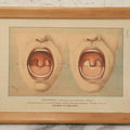 Lot 071 - Antique Skin Condition Medical Print, Diphtheria, From Photographs Of Skin Diseases Under The Direction Of George Henry Fox, M.D., Published By E.B. Treat, New York, In Custom Frame, 10-3/4" x 7-3/4"