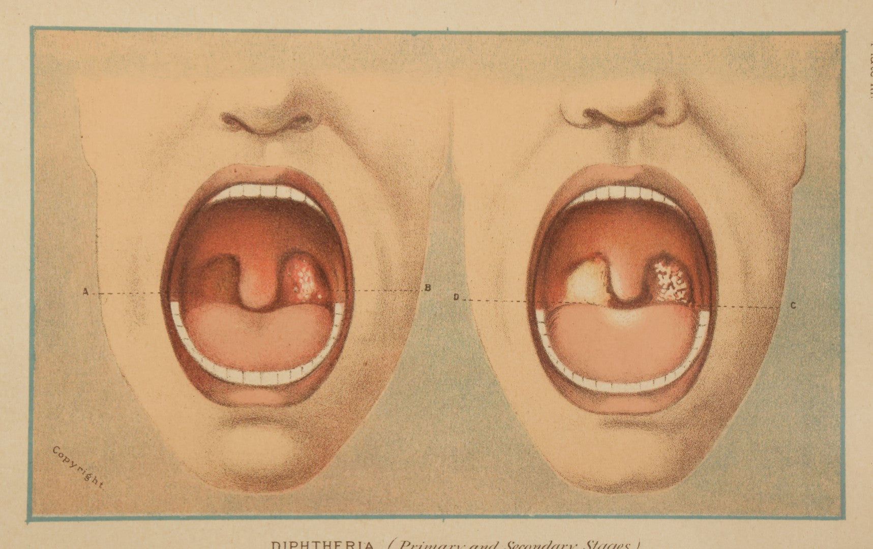 Lot 071 - Antique Skin Condition Medical Print, Diphtheria, From Photographs Of Skin Diseases Under The Direction Of George Henry Fox, M.D., Published By E.B. Treat, New York, In Custom Frame, 10-3/4" x 7-3/4"
