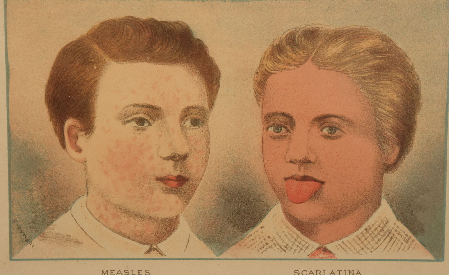 Lot 072 - Antique Skin Condition Medical Print, Measles & Scarlatina, From Photographs Of Skin Diseases Under The Direction Of George Henry Fox, M.D., Published By E.B. Treat, New York, In Custom Frame, 11" x 7-7/8"