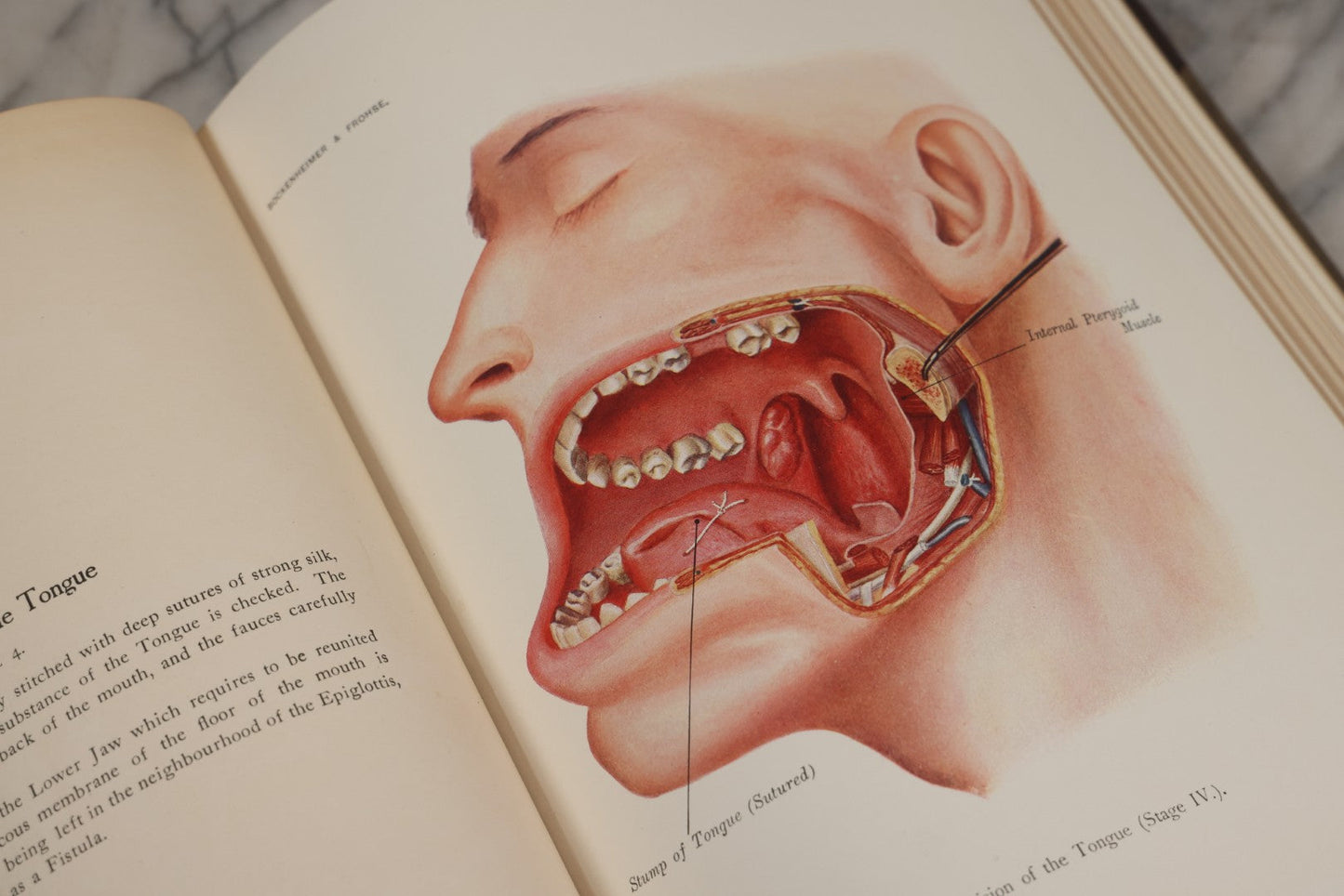 Lot 002 - "Atlas Of Typical Operations In Surgery" Antique Book By Dr. Ph. Bockenheimer & Dr. Fritz Frohse, With 60 Full Color Illustrations By Franz Frohse, English Adaptation By J. Howell Evans, Rebman Company, New York, Publishers, Circa 1900