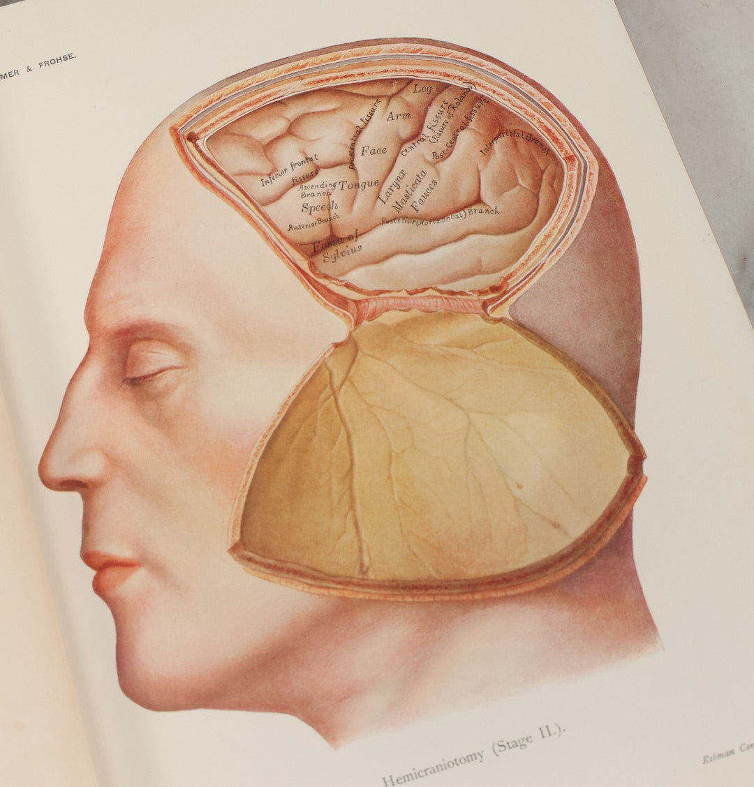 Lot 002 - "Atlas Of Typical Operations In Surgery" Antique Book By Dr. Ph. Bockenheimer & Dr. Fritz Frohse, With 60 Full Color Illustrations By Franz Frohse, English Adaptation By J. Howell Evans, Rebman Company, New York, Publishers, Circa 1900