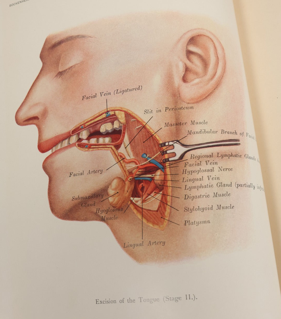 Lot 002 - "Atlas Of Typical Operations In Surgery" Antique Book By Dr. Ph. Bockenheimer & Dr. Fritz Frohse, With 60 Full Color Illustrations By Franz Frohse, English Adaptation By J. Howell Evans, Rebman Company, New York, Publishers, Circa 1900