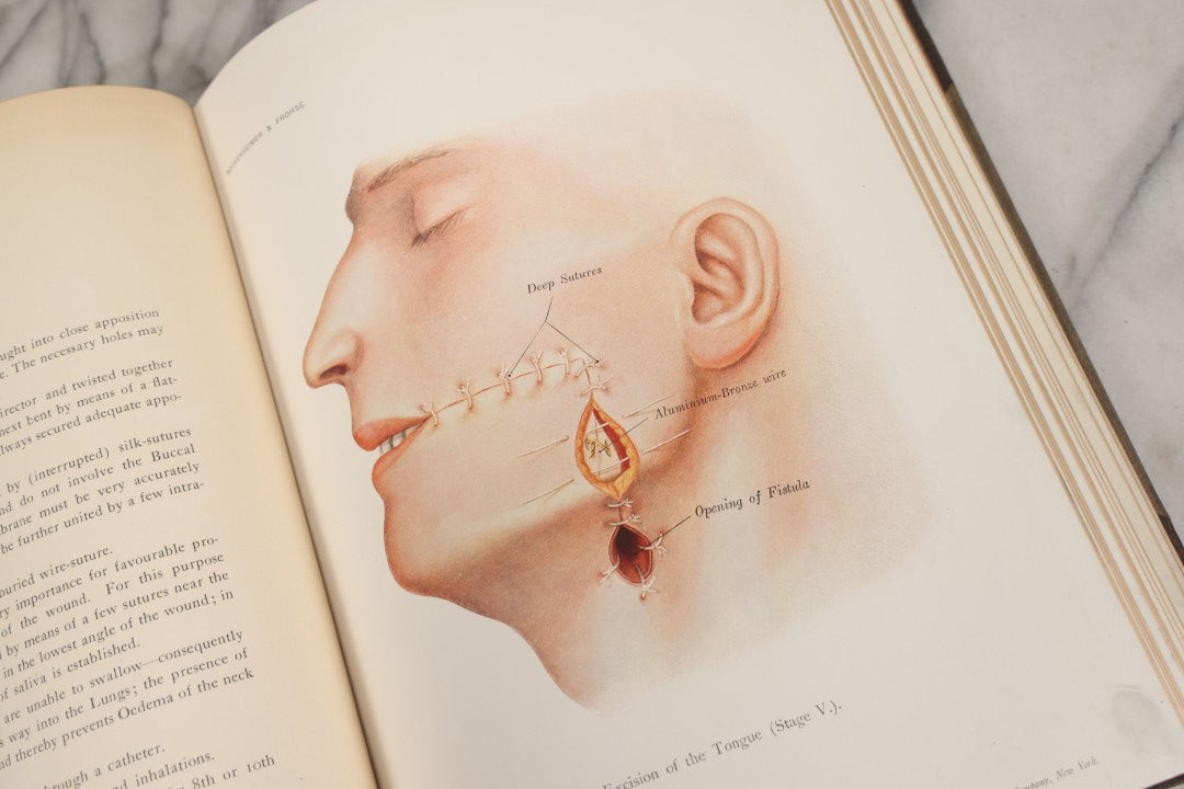 Lot 002 - "Atlas Of Typical Operations In Surgery" Antique Book By Dr. Ph. Bockenheimer & Dr. Fritz Frohse, With 60 Full Color Illustrations By Franz Frohse, English Adaptation By J. Howell Evans, Rebman Company, New York, Publishers, Circa 1900