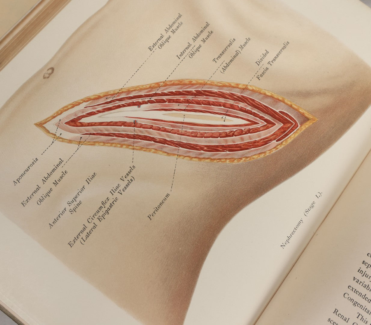 Lot 002 - "Atlas Of Typical Operations In Surgery" Antique Book By Dr. Ph. Bockenheimer & Dr. Fritz Frohse, With 60 Full Color Illustrations By Franz Frohse, English Adaptation By J. Howell Evans, Rebman Company, New York, Publishers, Circa 1900