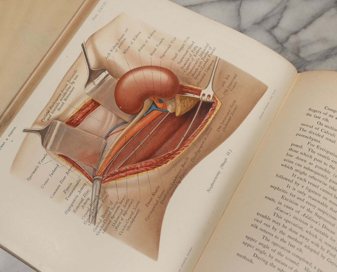 Lot 002 - "Atlas Of Typical Operations In Surgery" Antique Book By Dr. Ph. Bockenheimer & Dr. Fritz Frohse, With 60 Full Color Illustrations By Franz Frohse, English Adaptation By J. Howell Evans, Rebman Company, New York, Publishers, Circa 1900