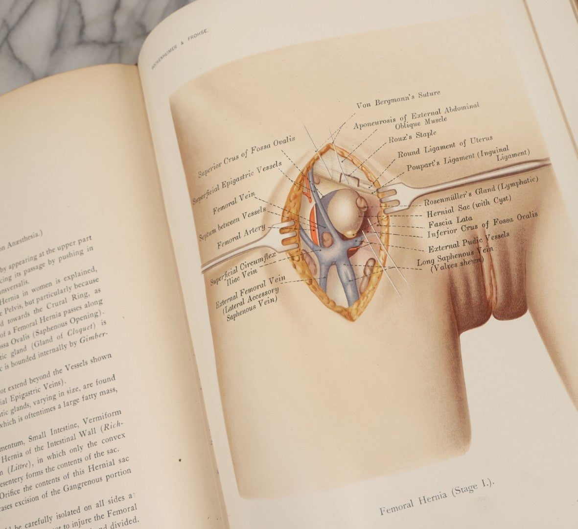 Lot 002 - "Atlas Of Typical Operations In Surgery" Antique Book By Dr. Ph. Bockenheimer & Dr. Fritz Frohse, With 60 Full Color Illustrations By Franz Frohse, English Adaptation By J. Howell Evans, Rebman Company, New York, Publishers, Circa 1900